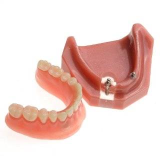 Generic Dental Study Teachinging Model Teeth Implant Repair Model Color Yellow Health & Personal Care